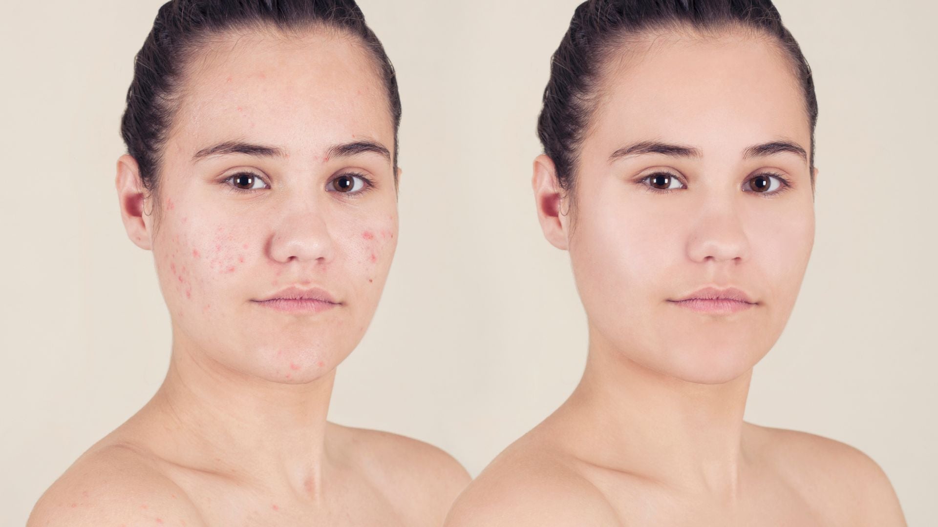 Acne Solutions 101: The Power of Salicylic Acid & Tea Tree Extract